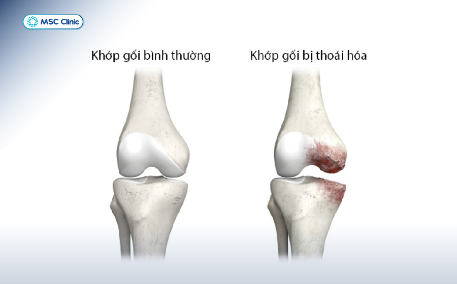 Viêm khớp gối uống thuốc gì để điều trị hiệu quả-04