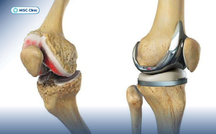 Viêm khớp gối uống thuốc gì để điều trị hiệu quả-07