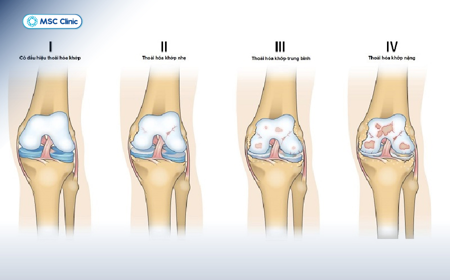 Viêm khớp gối và cách điều trị hiệu quả-04