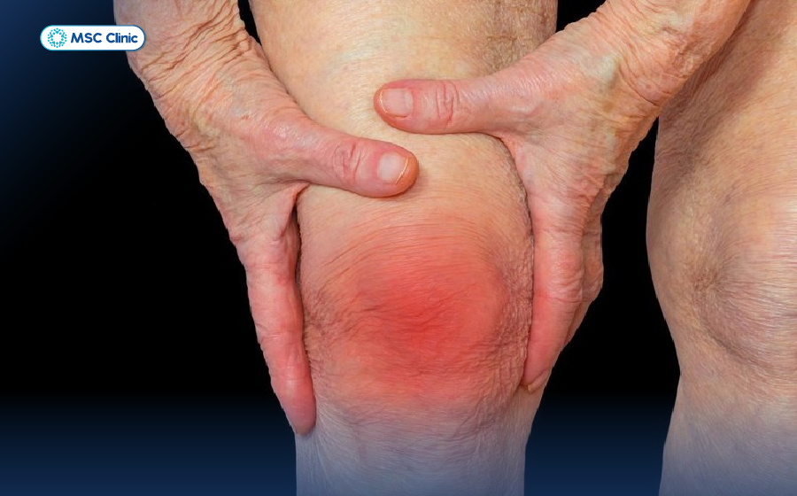 Viêm khớp gối và cách điều trị hiệu quả-05
