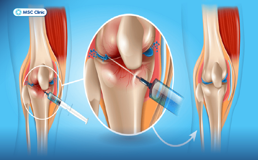 Viêm khớp gối và cách điều trị hiệu quả-09