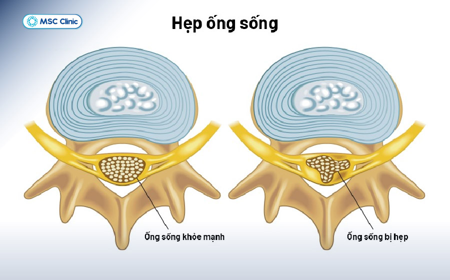 Đau lưng bên phải là bệnh gì-07