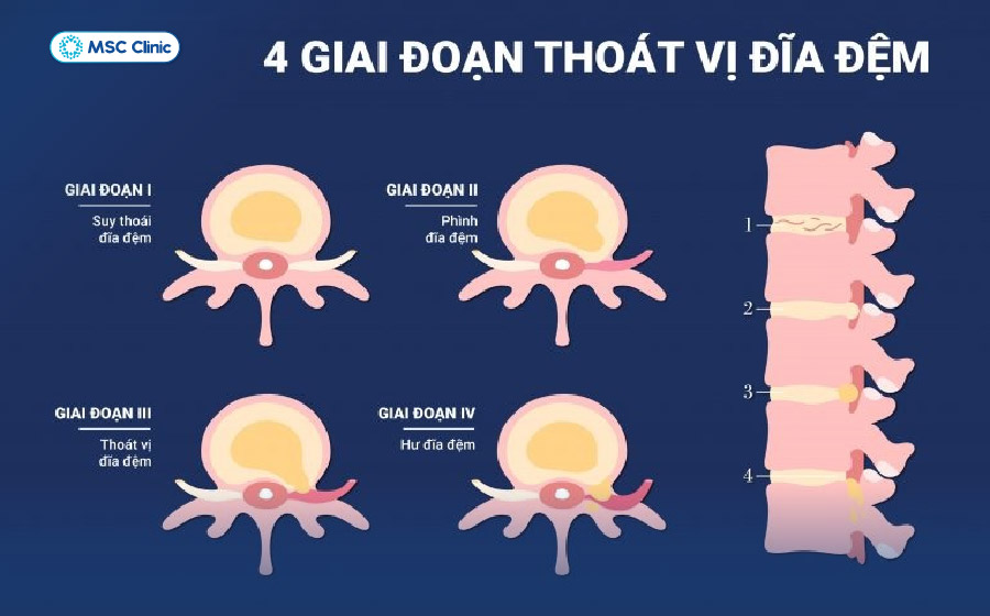 Đau lưng bên phải là bệnh gì-08