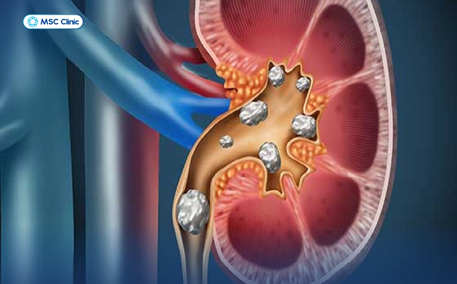 Đau lưng bên phải là bệnh gì-13