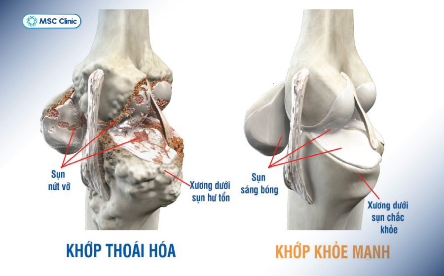 Viêm đa khớp Nguyên nhân, triệu chứng và điều trị-05