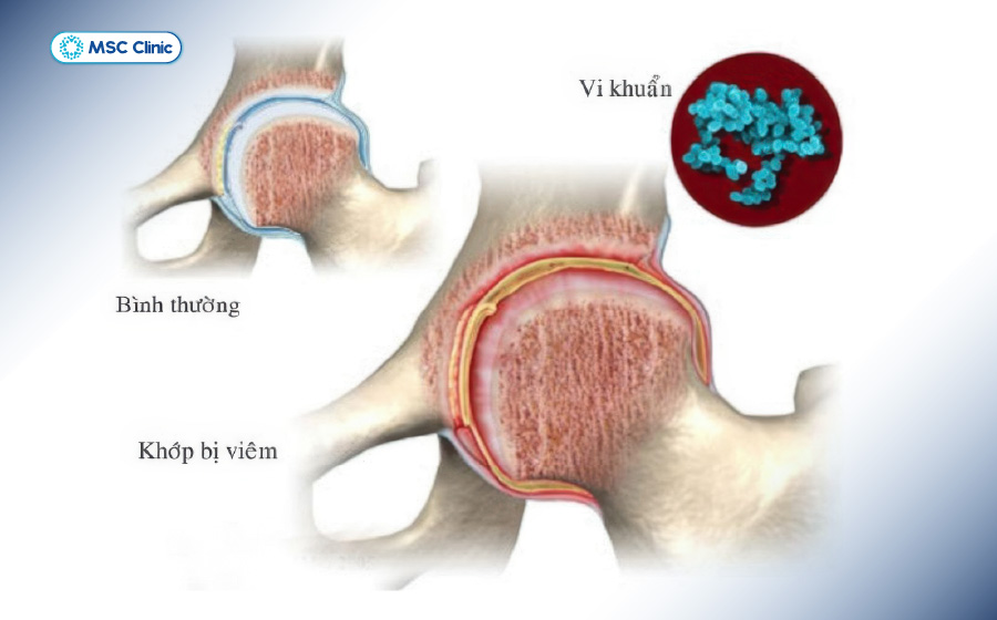 Viêm đa khớp Nguyên nhân, triệu chứng và điều trị-06