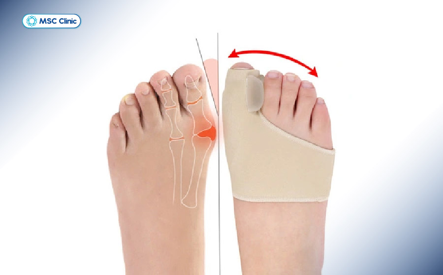 Cố định ngón chân giúp giữ khớp ổn định, giảm đau và cải thiện trật khớp