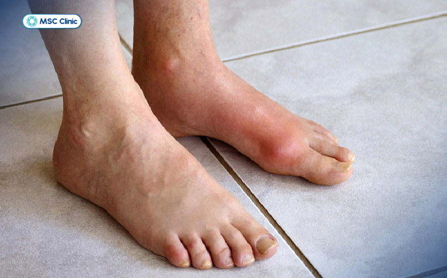 Gout là nguyên nhân làm tăng nguy cơ dẫn đến trật khớp ngón chân