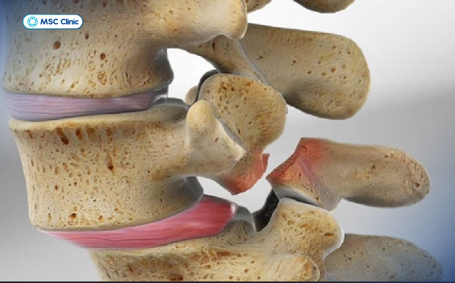 Hở eo đốt sống là tình trạng bẩm sinh gây nguy cơ trật khớp cao Hở eo đốt sống là tình trạng bẩm sinh gây nguy cơ trật khớp cao