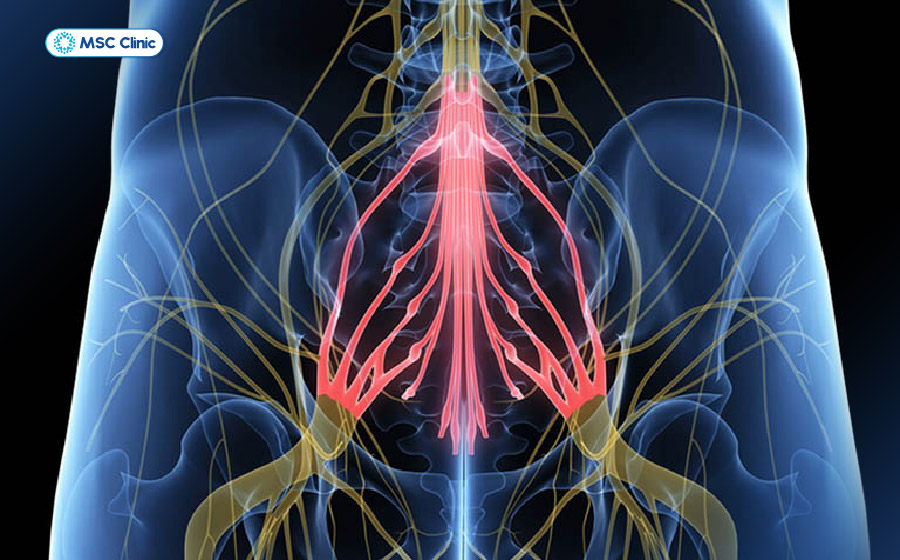 Hội chứng chùm đuôi ngựa xảy ra khi đốt sống chèn ép tủy sống hoặc rễ thần kinh Hội chứng chùm đuôi ngựa xảy ra khi đốt sống chèn ép tủy sống hoặc rễ thần kinh