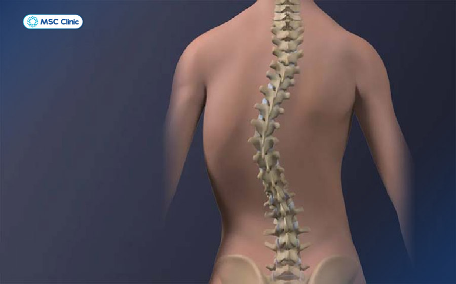 Trật khớp lưng không được điều trị có thể gây biến dạng cột sống Trật khớp lưng không được điều trị có thể gây biến dạng cột sống