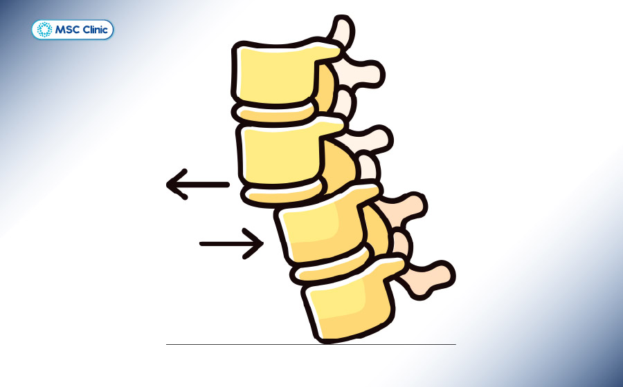 Trật khớp lưng là tình trạng mất kết nối của hai đốt sống kế tiếp nhau Trật khớp lưng là tình trạng mất kết nối của hai đốt sống kế tiếp nhau