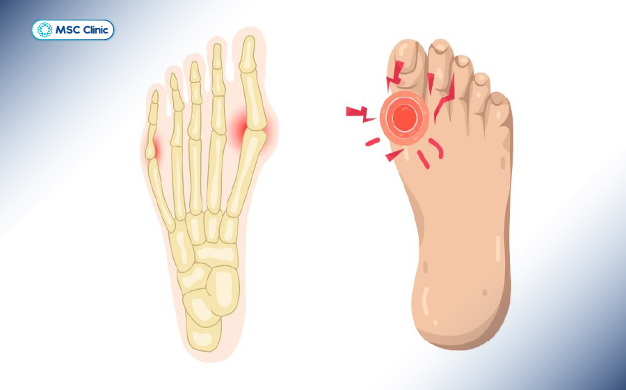 Trật khớp ngón chân gây ra những cơn đau khó chịu