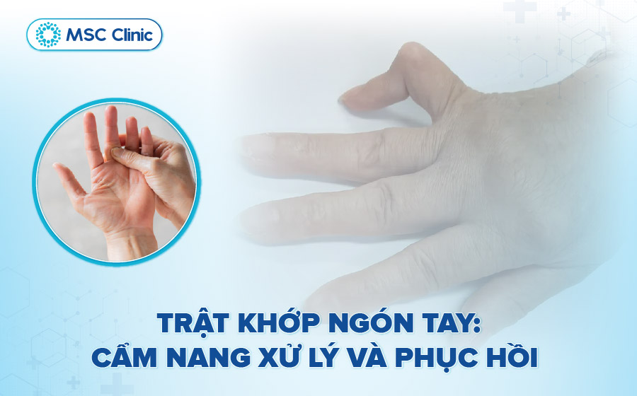 Trật khớp ngón tay xử lý thế nào? 2 cách điều trị hiệu quả