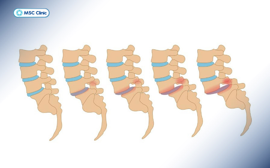 Tỷ lệ trượt của đốt sống càng lớn thì tình trạng trật khớp lưng càng nghiêm trọng Tỷ lệ trượt của đốt sống càng lớn thì tình trạng trật khớp lưng càng nghiêm trọng