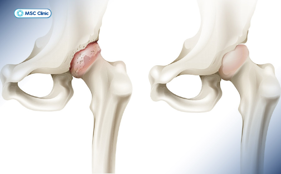 Viêm khớp háng ở trẻ em-03