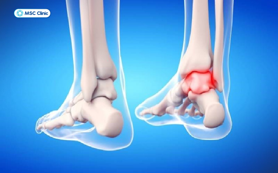 Viêm khớp mắt cá chân-03