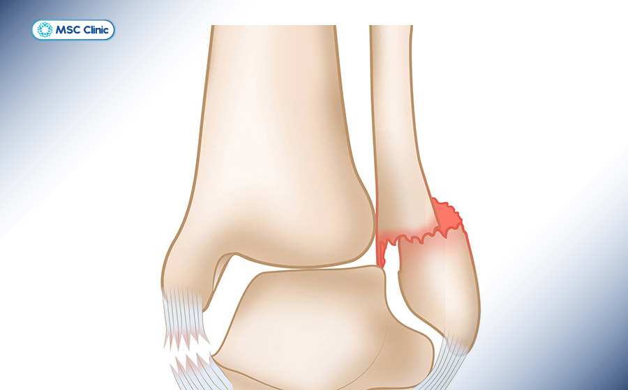 Viêm khớp mắt cá chân-05