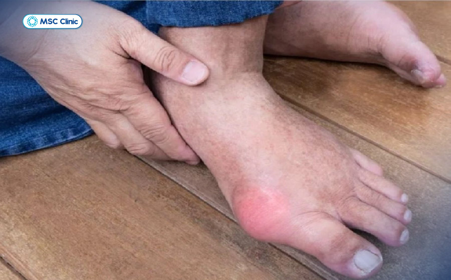 Viêm khớp mắt cá chân-06