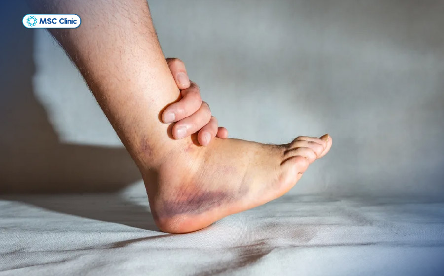 Viêm khớp mắt cá chân-07