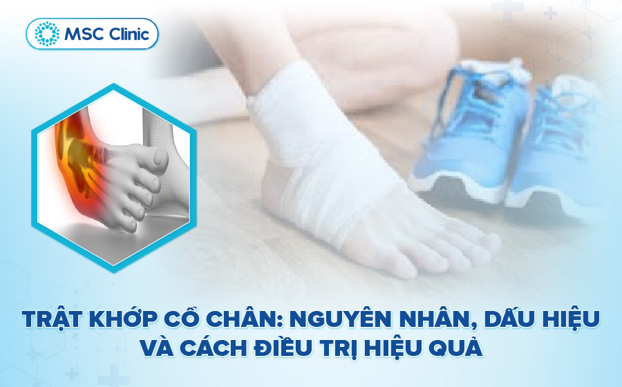 Trật khớp cổ chân nên xử lý thế nào? Dấu hiệu và nguyên nhân