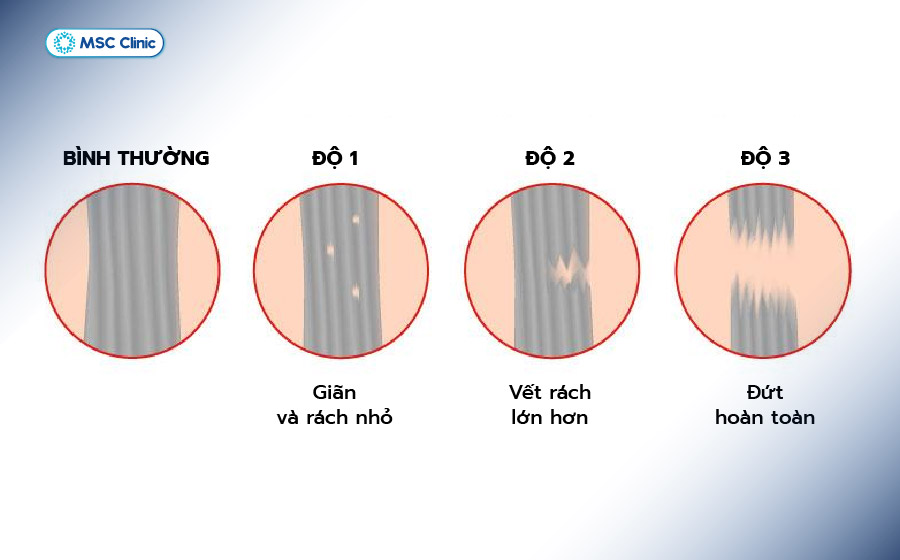 Đứt dây chằng chéo trước được chia thành 3 cấp độ tổn thương