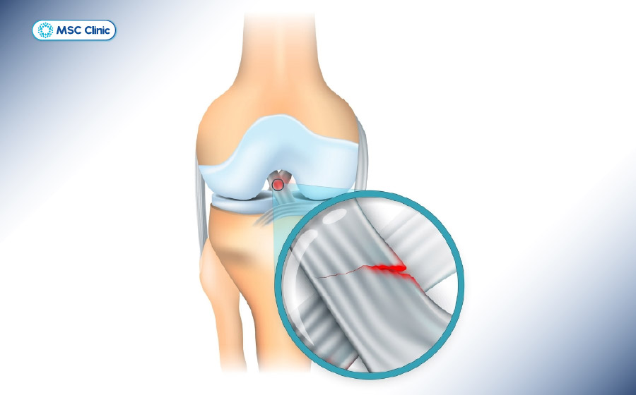 Đứt dây chằng chéo trước là chấn thương thường gặp