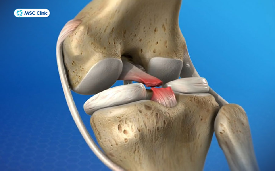Hình ảnh đứt dây chằng chéo trước điển hình tại đầu gối