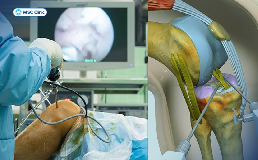 Phẫu thuật nội soi điều trị đứt dây chằng chéo trước