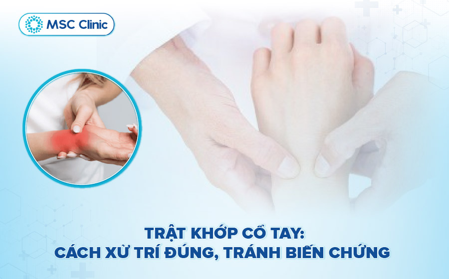 Trật khớp cổ tay: Cách xử lý đúng và 5 dấu hiệu cần biết