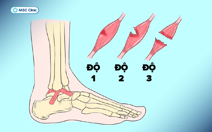 3 mức độ của tình trạng bong gân mắt cá chân