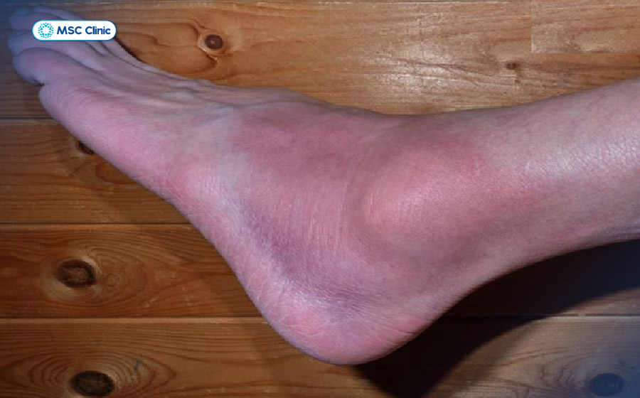 Bong gân mắt cá chân gây bầm tím