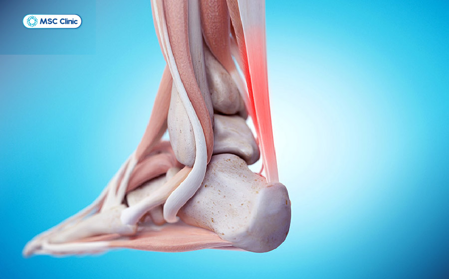 Bong gân mắt cá chân kéo dài dễ dẫn đến viêm gân