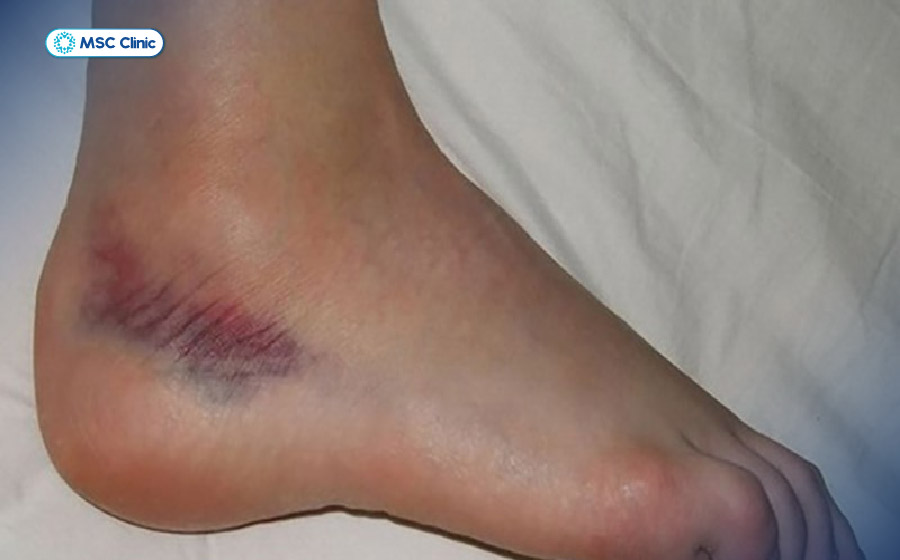 Mắt cá chân tím tái, sưng nề gây đau nhức cho người bệnh