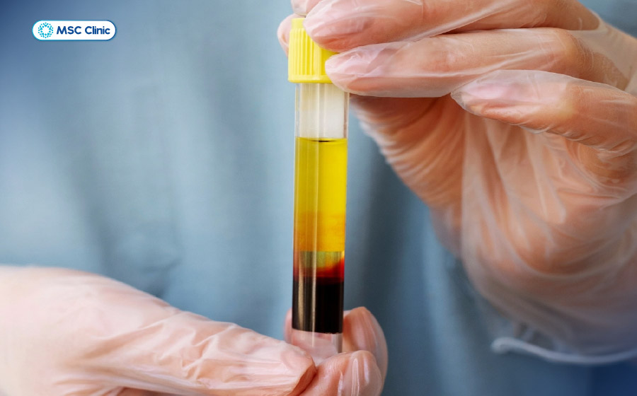 PRP chứa nồng độ cao tiểu cầu và các yếu tố tăng trưởng