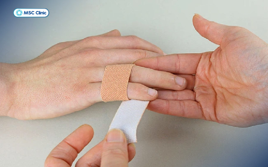 Băng ép cố định ngón tay giúp giảm sưng tấy, giữ cho khớp ngón tay ổn định