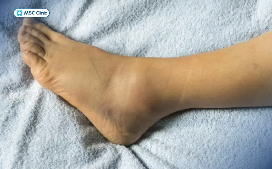 Bong gân cổ chân gây nên đau khớp cổ chân