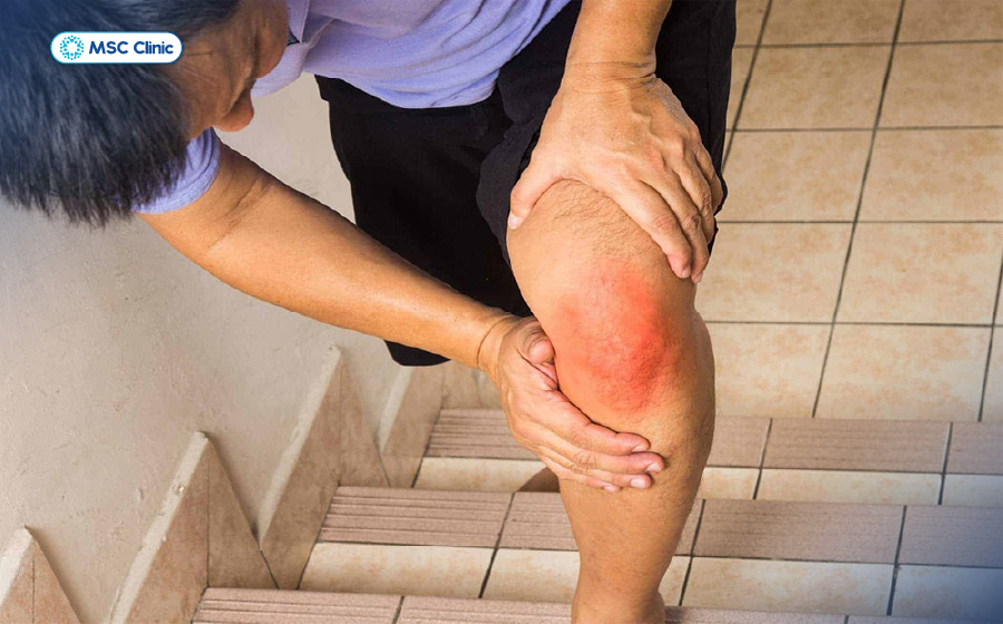 Bong gân đầu gối gây đau nhức và ảnh hưởng lớn đến sinh hoạt