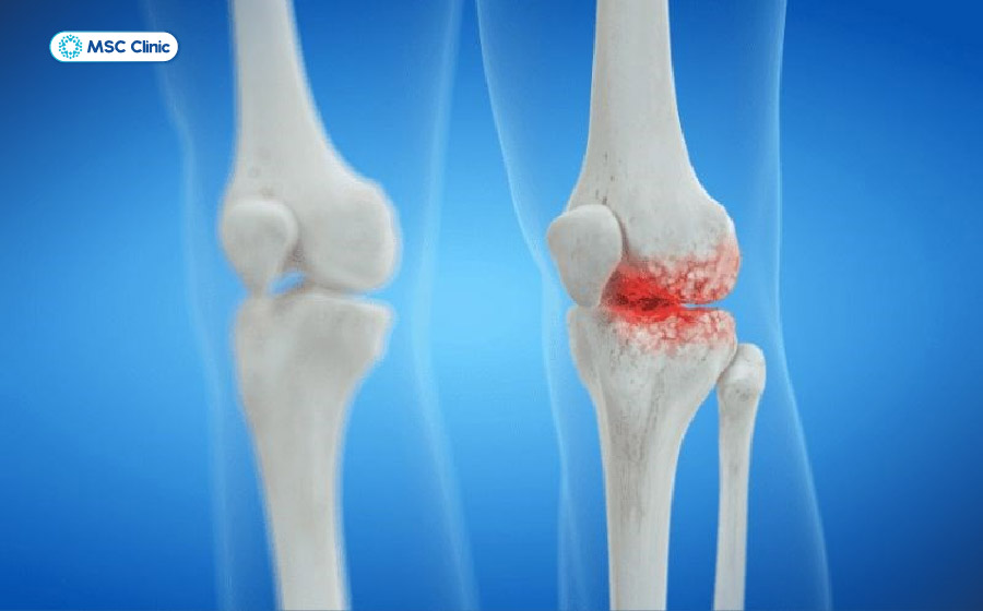 Bong gân đầu gối không được điều trị có thể dẫn tới nguy cơ thoái hóa khớp gối