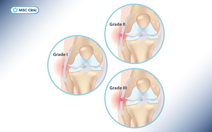 Bong gân đầu gối theo các cấp độ