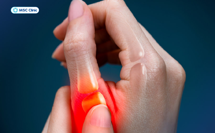 Bong gân ngón tay gây khó chịu, ảnh hưởng đến sinh hoạt hàng ngày