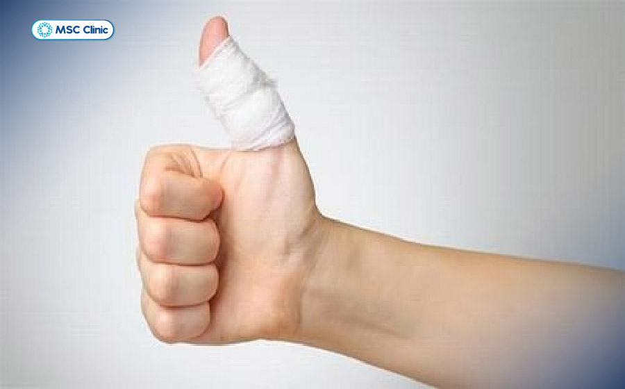 Bong gân ngón tay là chấn thương thường gặp, đặc biệt với người chơi thể thao