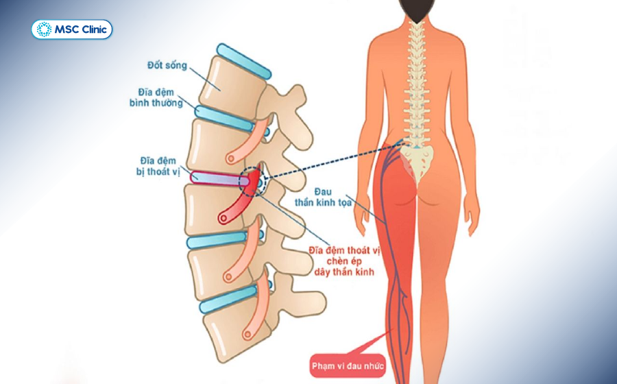 Chèn ép cơ học do đĩa đệm thoát vị gây đau thần kinh tọa Chèn ép cơ học do đĩa đệm thoát vị gây đau thần kinh tọa