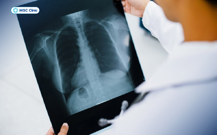 Chụp X-quang lồng ngực/cột sống ngực để tìm nguyên nhân chèn ép như gãy xương, thoái hoá
