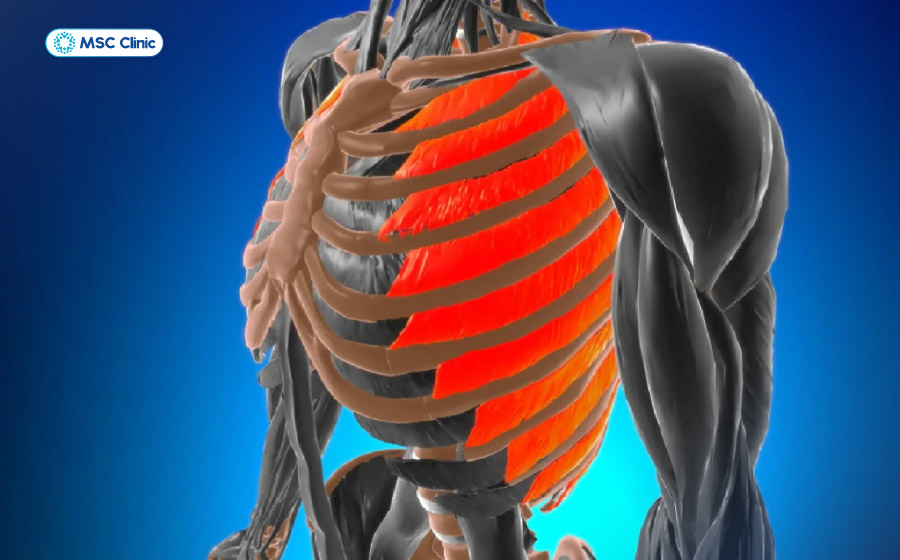 Đau cơ liên sườn là tình trạng đau dọc theo khoang sườn, gây khó chịu khi hít thở