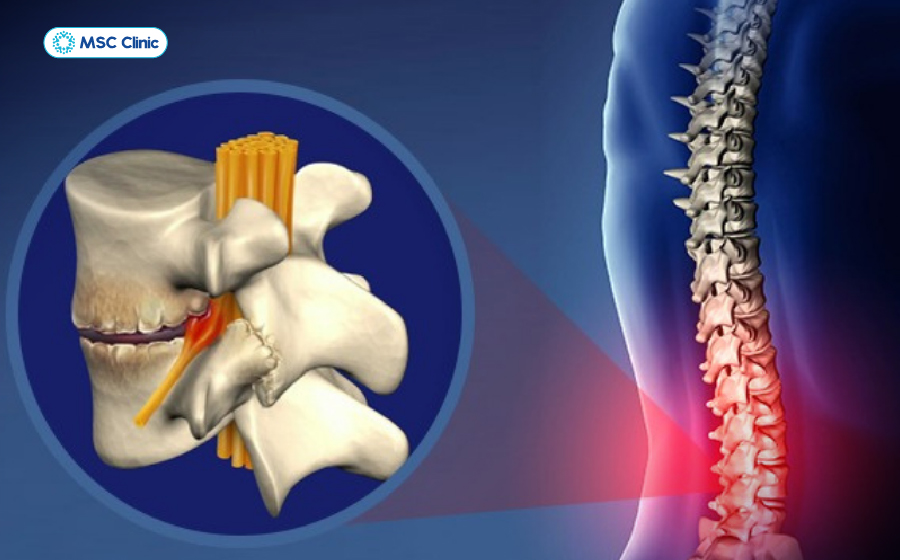 Đau lưng mỏi gối tê tay có thể là dấu hiệu của thoái hóa cột sống