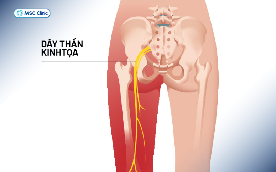 Đau thần kinh tọa là tình trạng nhiều người gặp phải Đau thần kinh tọa là tình trạng nhiều người gặp phải