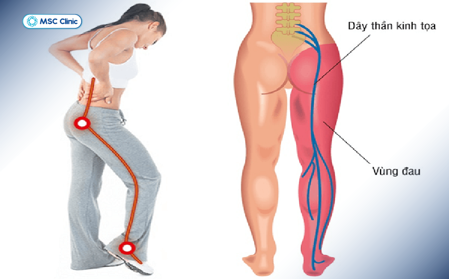 Điểm đau có thể gặp phải Điểm đau có thể gặp phải