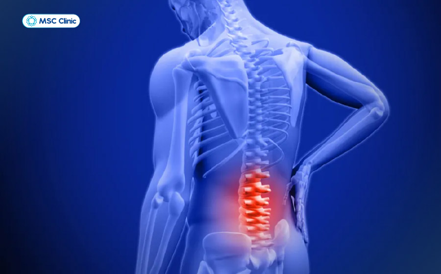 Gai cột sống thắt lưng là tình trạng cơ xương khớp phổ biến