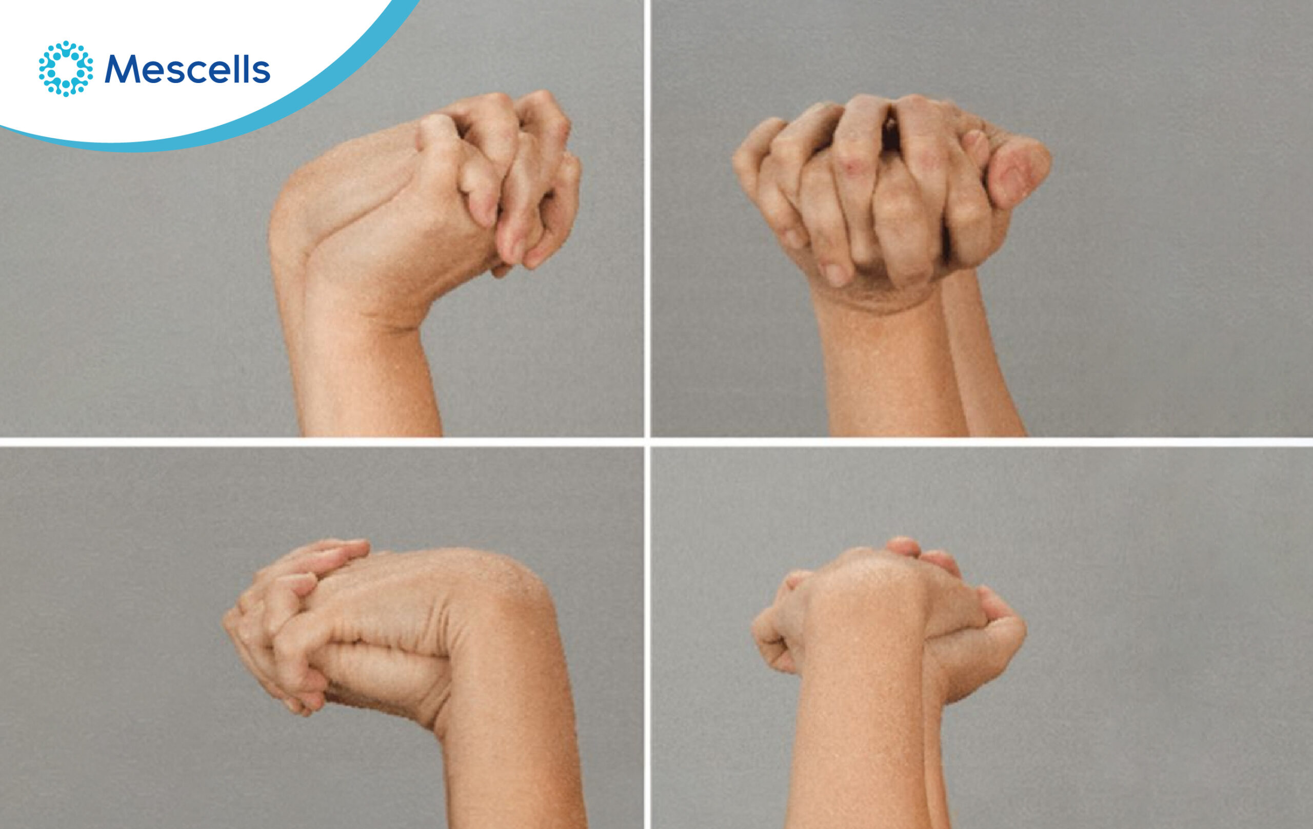 Gập cổ tay quá mức trong một thời gian dày tạo áp lực cho dây thần kinh trong ống cổ tay Gập cổ tay quá mức trong một thời gian dày tạo áp lực cho dây thần kinh trong ống cổ tay